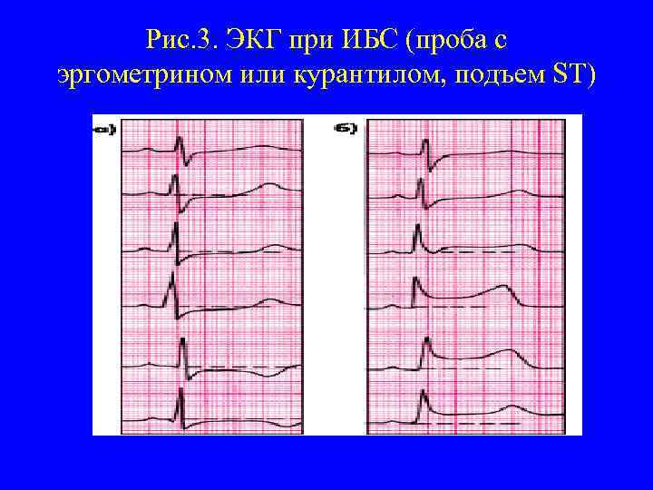 Рис. 3. ЭКГ при ИБС (проба с эргометрином или курантилом, подъем ST) 