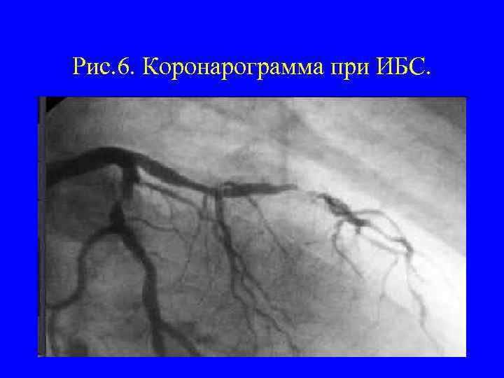 Рис. 6. Коронарограмма при ИБС. 