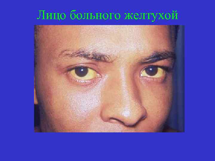 Лицо больного желтухой 