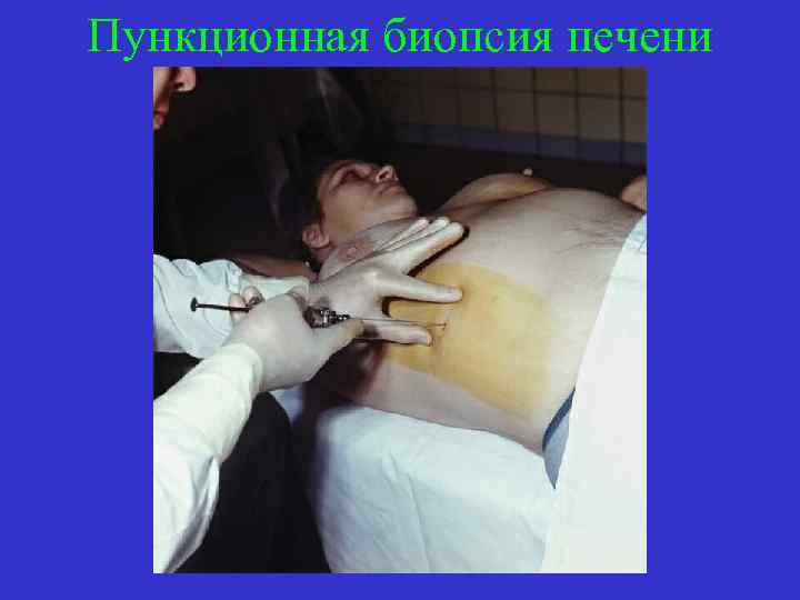 Пункционная биопсия печени 