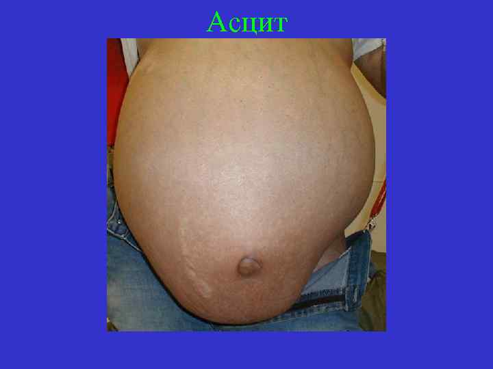 Асцит 
