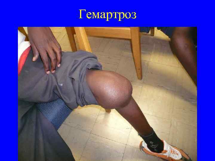 Гемартроз 