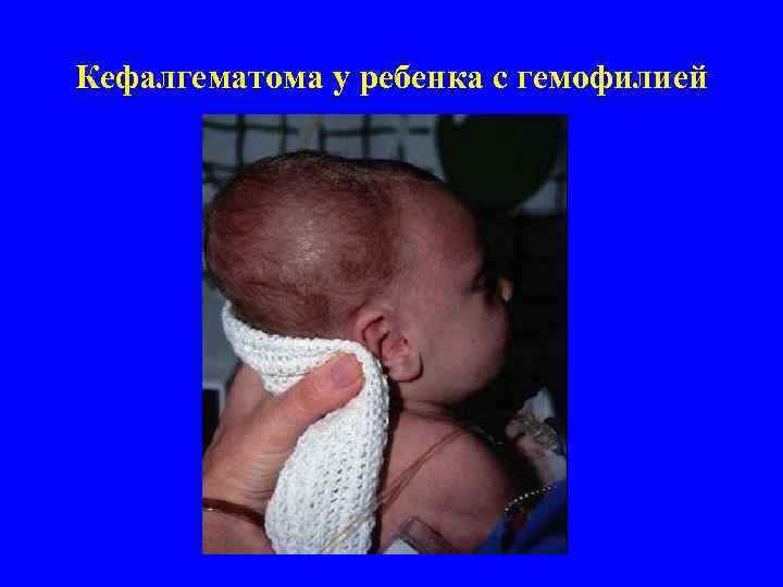 Кефалгематома у ребенка с гемофилией 