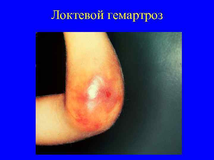 Локтевой гемартроз 
