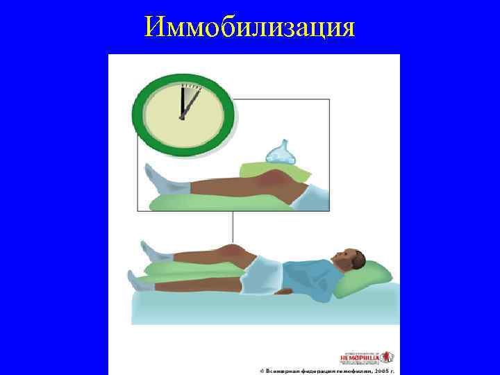 Иммобилизация 