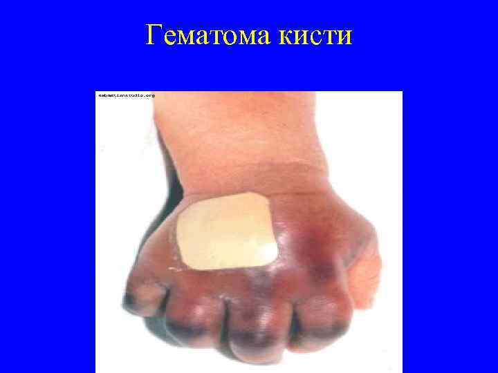 Гематома кисти 