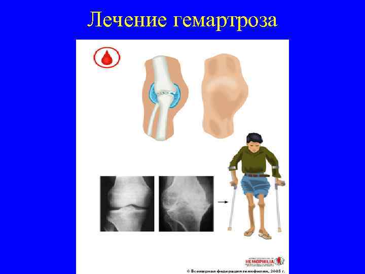 Лечение гемартроза 