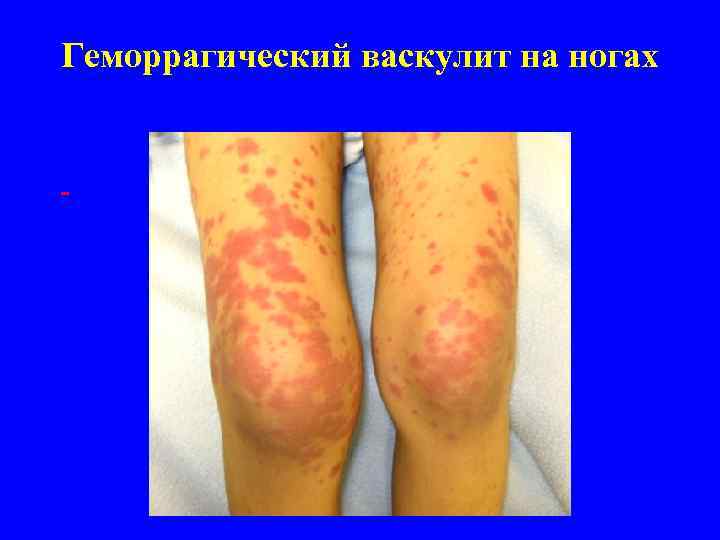 Геморрагический васкулит на ногах 