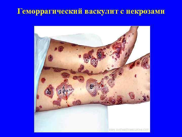 Геморрагический васкулит с некрозами 