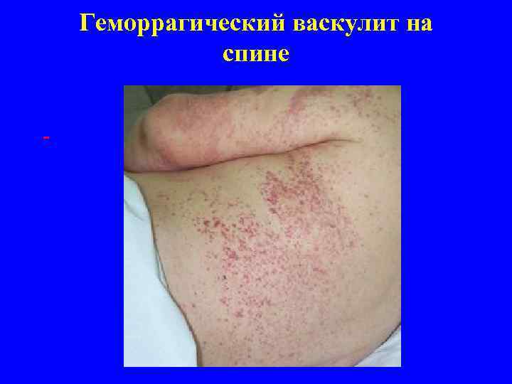 Геморрагический васкулит на спине 