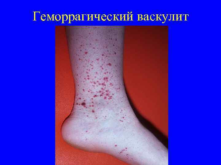 Геморрагический васкулит 