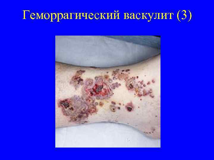 Геморрагический васкулит (3) 