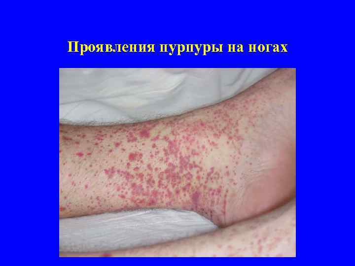 Проявления пурпуры на ногах 