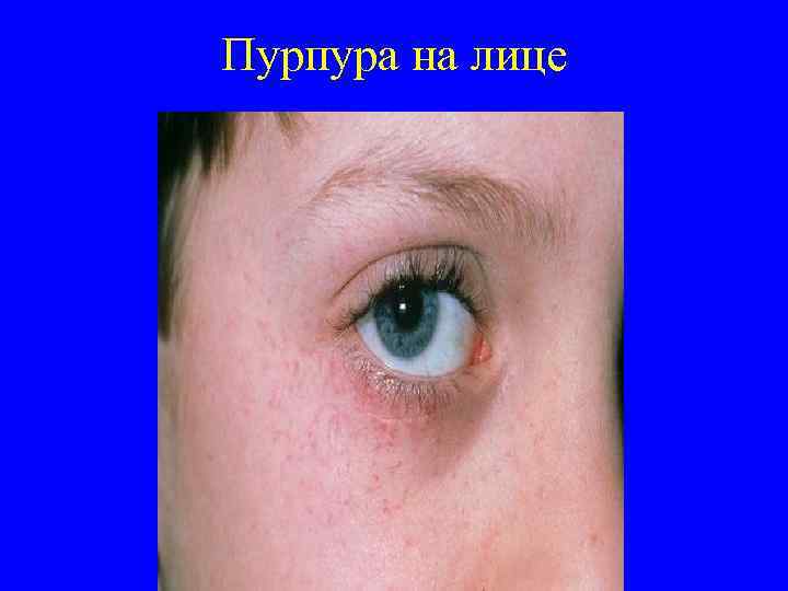 Пурпура на лице 