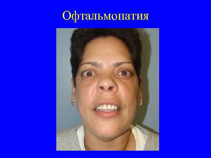 Офтальмопатия 