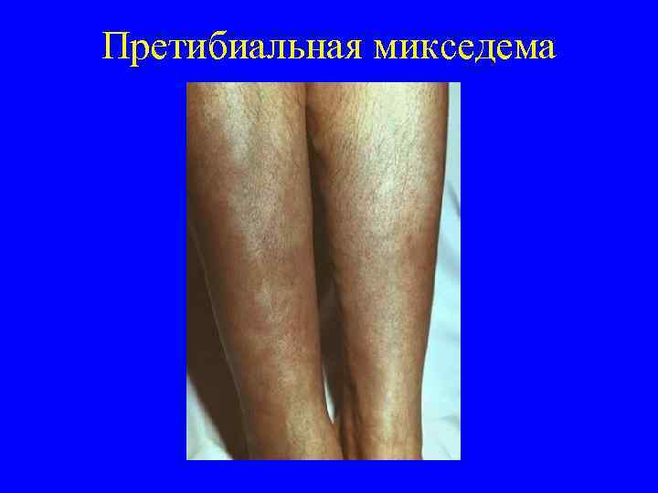 Претибиальная микседема 