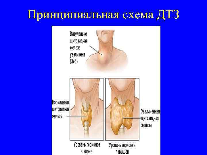 Принципиальная схема ДТЗ 