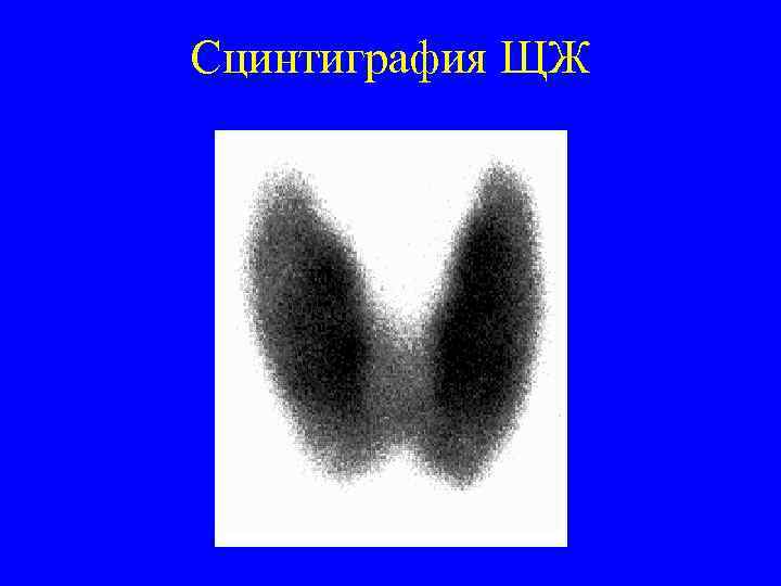 Сцинтиграфия ЩЖ 