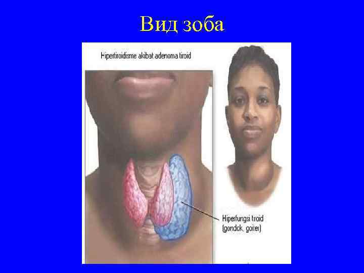 Вид зоба 