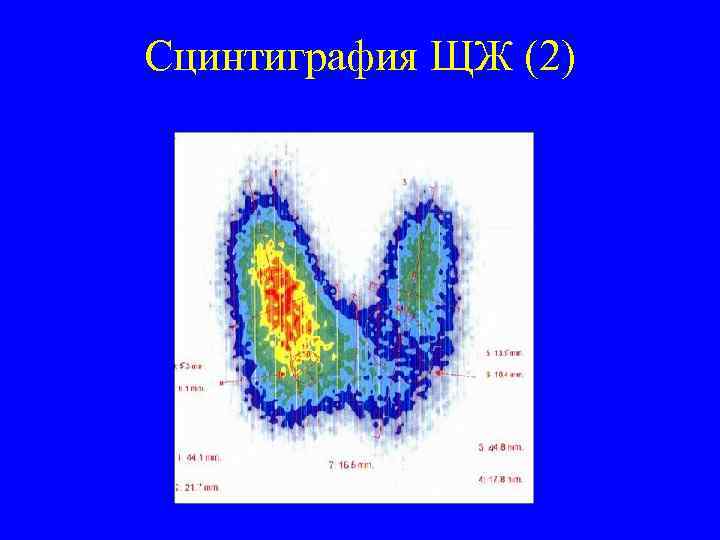 Сцинтиграфия ЩЖ (2) 