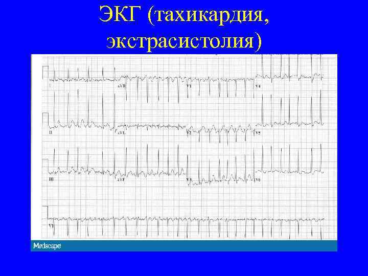 ЭКГ (тахикардия, экстрасистолия) 