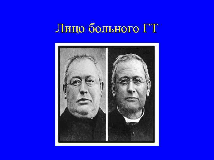 Лицо больного ГТ 