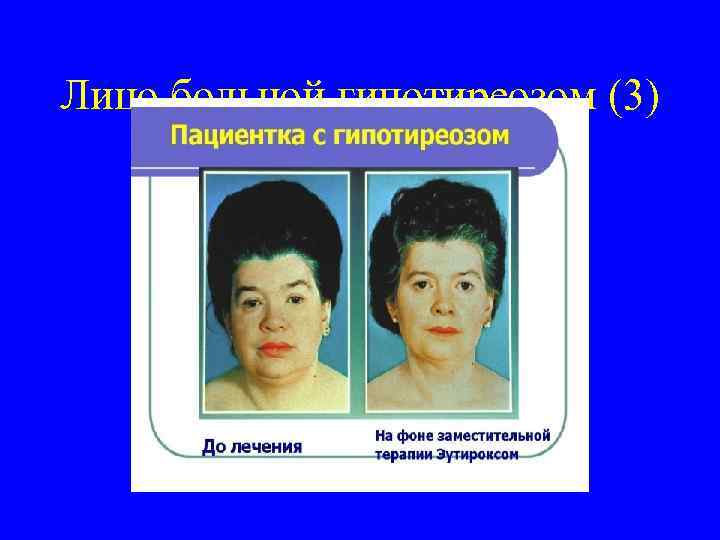 Лицо больной гипотиреозом (3) 
