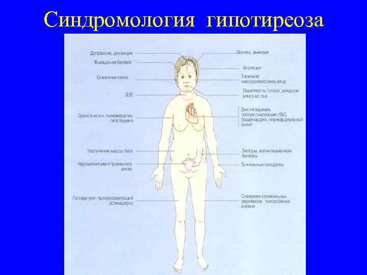 Синдромология гипотиреоза 