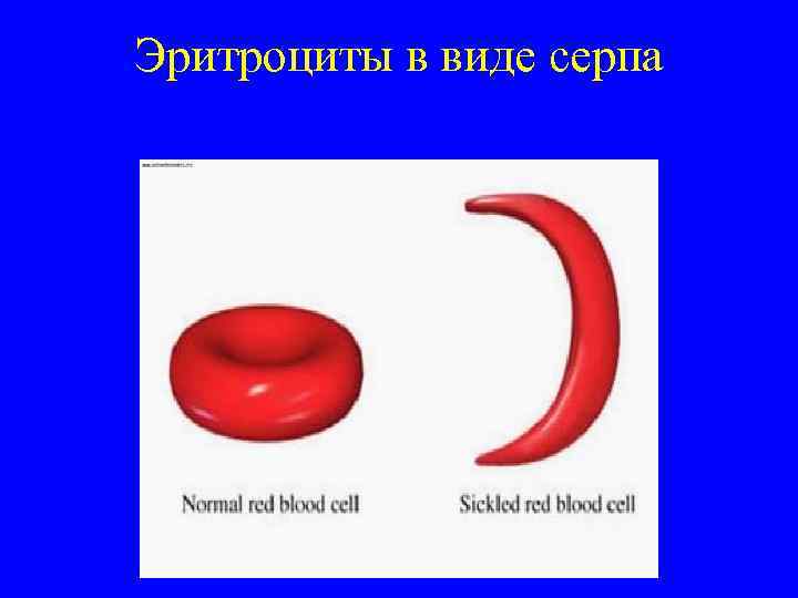 Эритроциты в виде серпа 