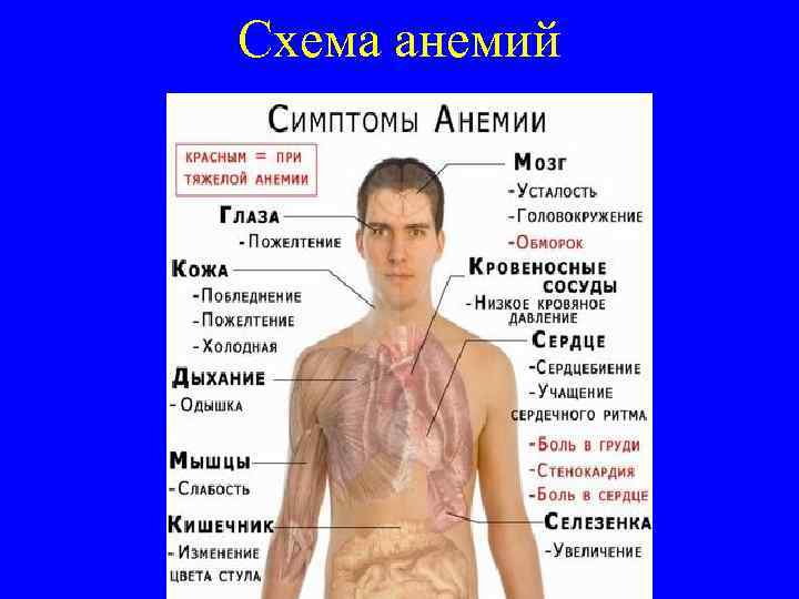 Схема анемий 