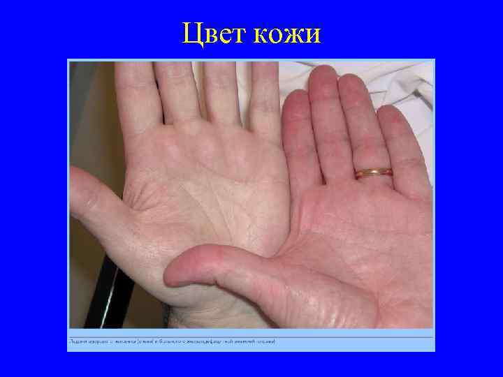 Цвет кожи 