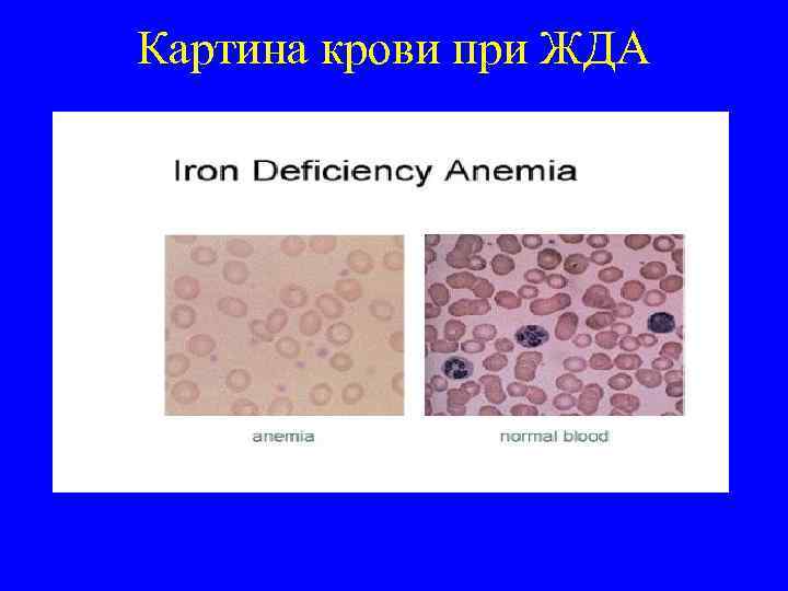 Картина крови при ЖДА 