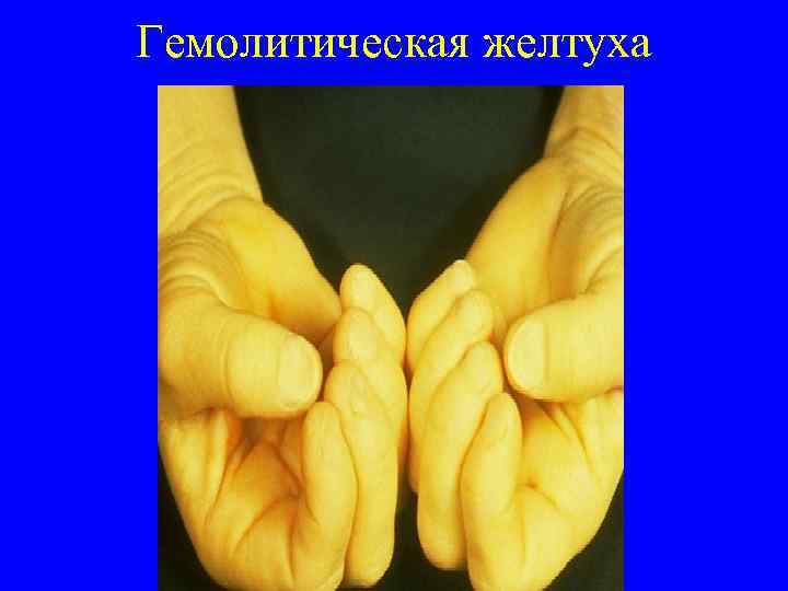 Гемолитическая желтуха 