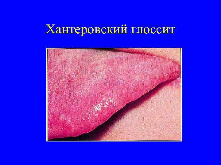 Хантеровский глоссит 