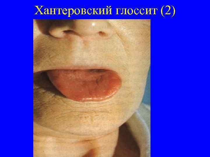 Хантеровский глоссит (2) 