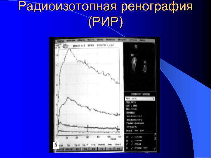 Радиоизотопная ренография (РИР) 