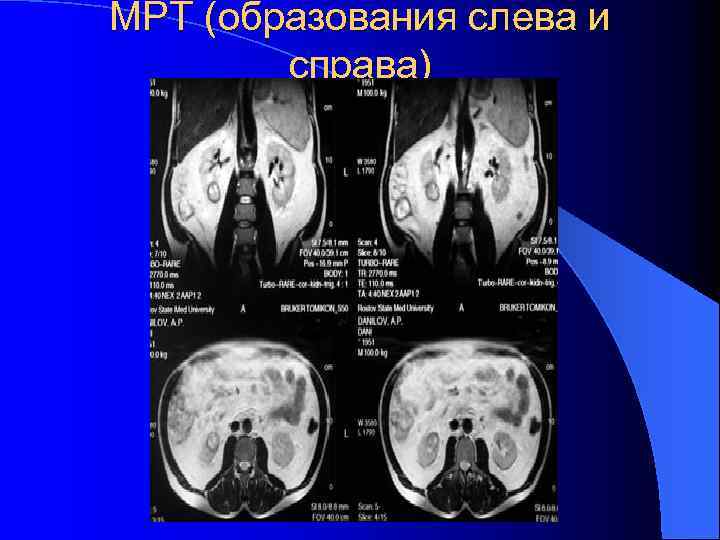 МРТ (образования слева и справа) 