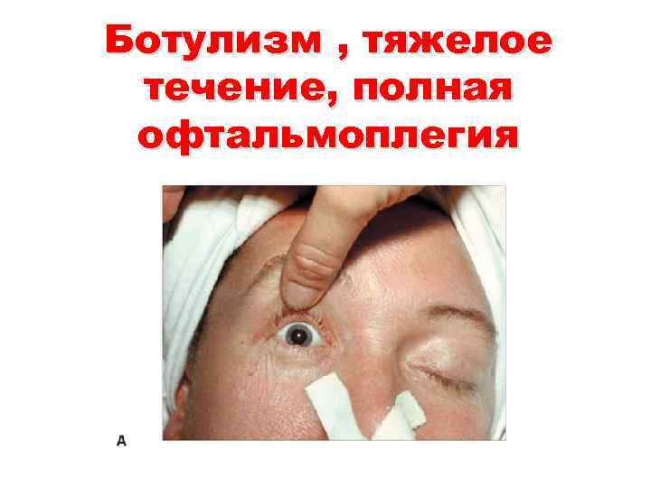Ботулизм , тяжелое течение, полная офтальмоплегия 