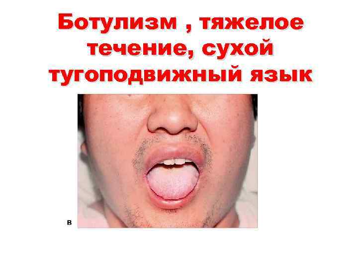 Ботулизм , тяжелое течение, сухой тугоподвижный язык 