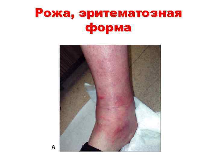 Рожа, эритематозная форма 