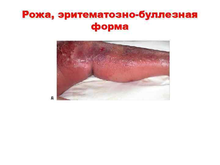 Рожа, эритематозно-буллезная форма 