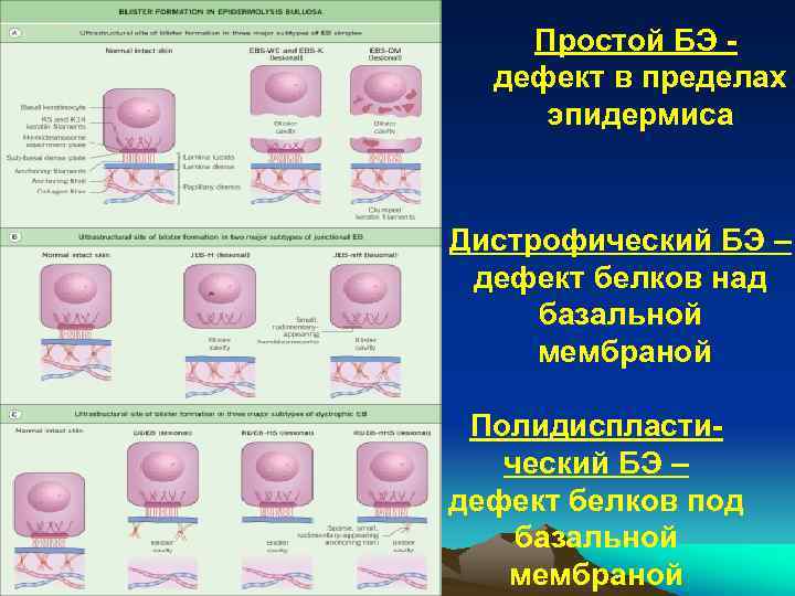 Простой БЭ дефект в пределах эпидермиса Дистрофический БЭ – дефект белков над базальной мембраной