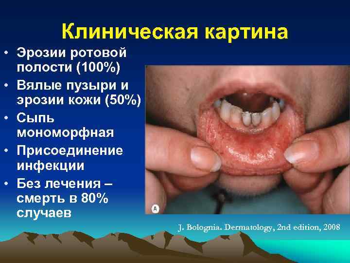 Клиническая картина • Эрозии ротовой полости (100%) • Вялые пузыри и эрозии кожи (50%)