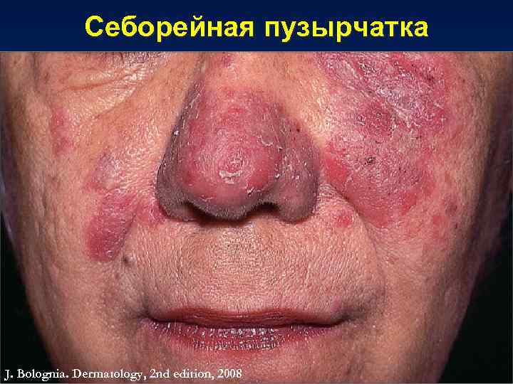 Себорейная пузырчатка J. Bolognia. Dermatology, 2 nd edition, 2008 