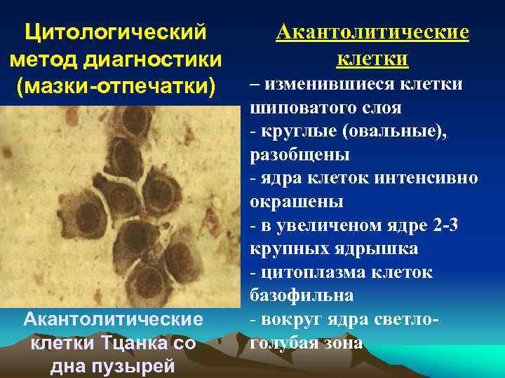 Цитологический метод диагностики (мазки-отпечатки) Акантолитические клетки Тцанка со дна пузырей Акантолитические клетки – изменившиеся