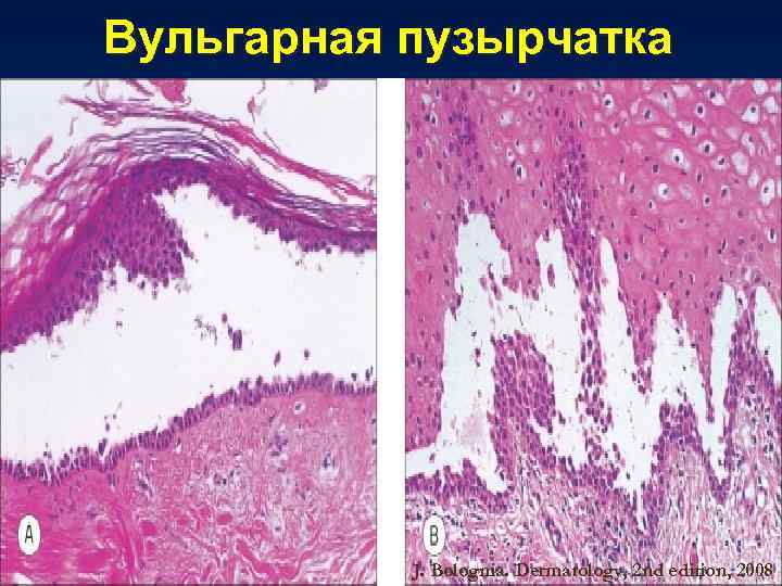 Вульгарная пузырчатка J. Bolognia. Dermatology, 2 nd edition, 2008 