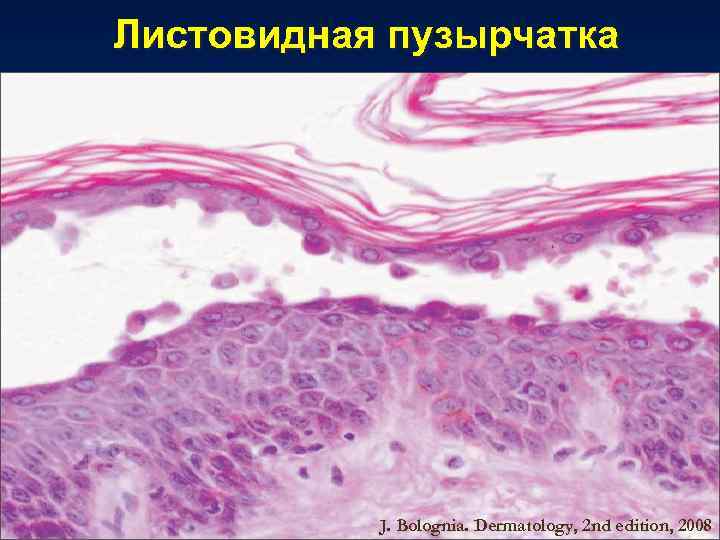 Листовидная пузырчатка J. Bolognia. Dermatology, 2 nd edition, 2008 