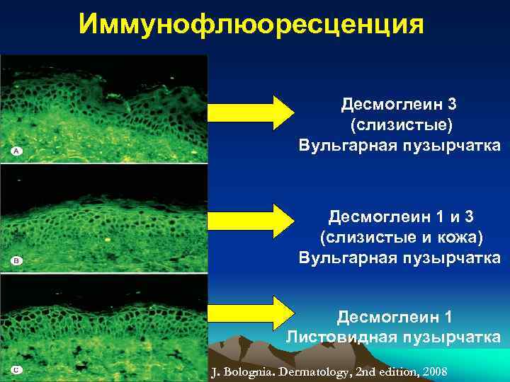 Иммунофлюоресценция Десмоглеин 3 (слизистые) Вульгарная пузырчатка Десмоглеин 1 и 3 (слизистые и кожа) Вульгарная