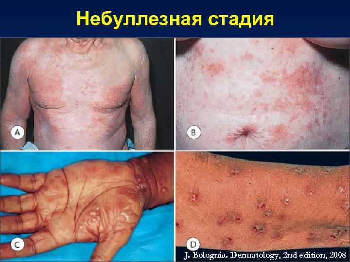 Небуллезная стадия J. Bolognia. Dermatology, 2 nd edition, 2008 