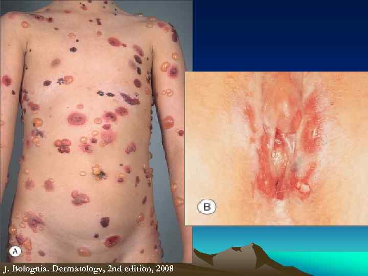 J. Bolognia. Dermatology, 2 nd edition, 2008 